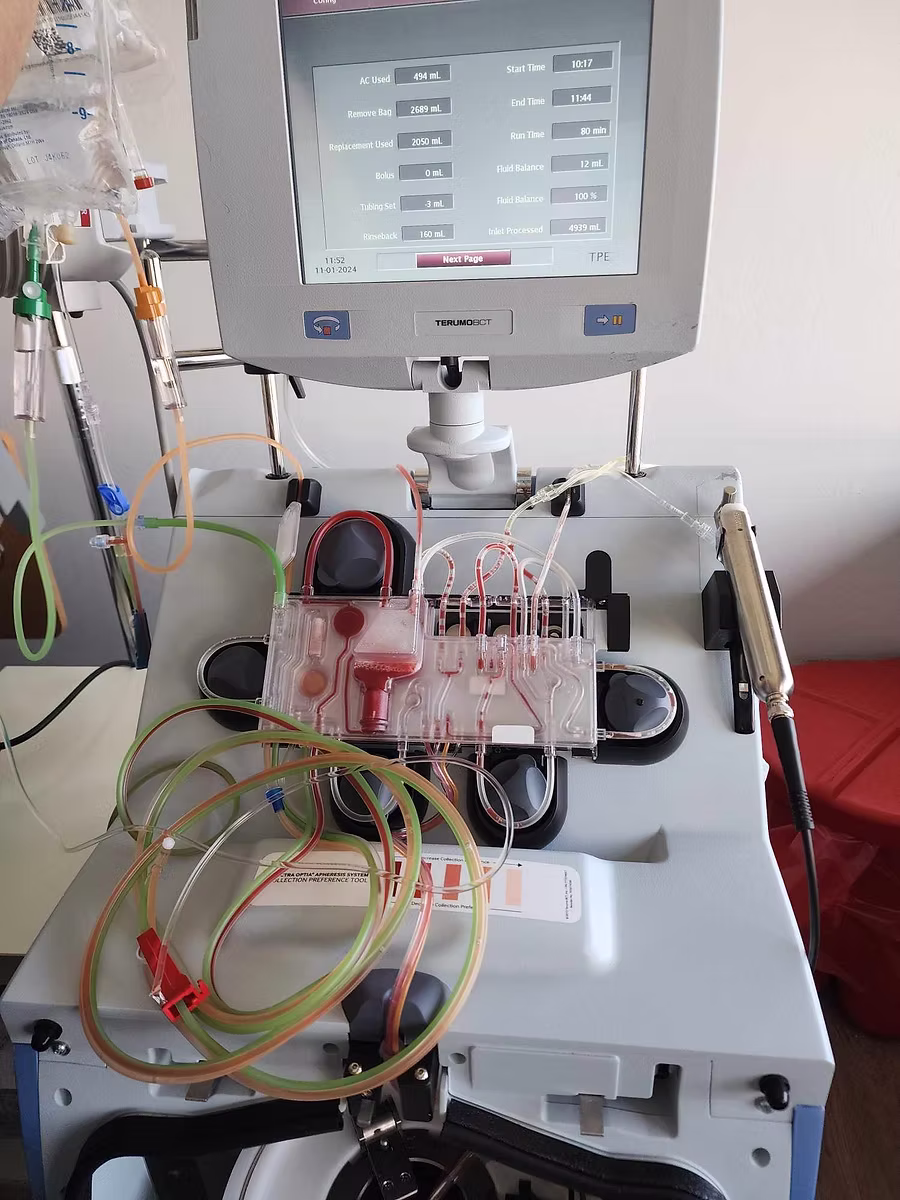 Apheresis machine used for therapeutic plasma exchange